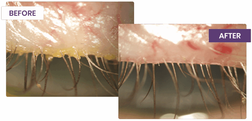 Blephex treatment